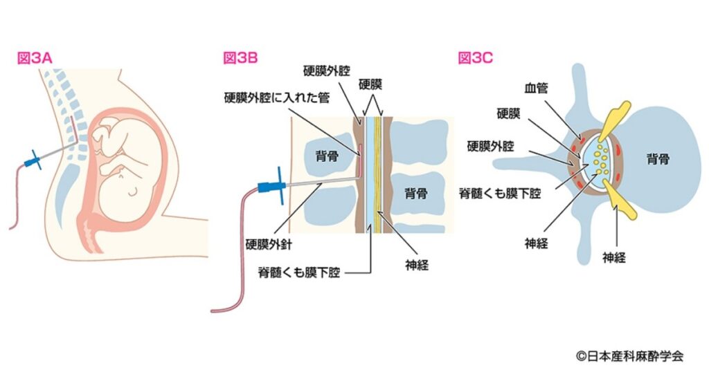 硬膜外麻酔